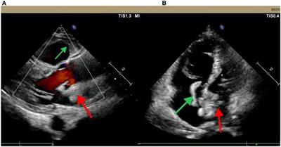 AngioJet thrombectomy with extracorporeal membrane oxygenation support for an acute large-scale pulmonary embolism with bilateral atrial thrombosis: a case report of catastrophic antiphospholipid syndrome